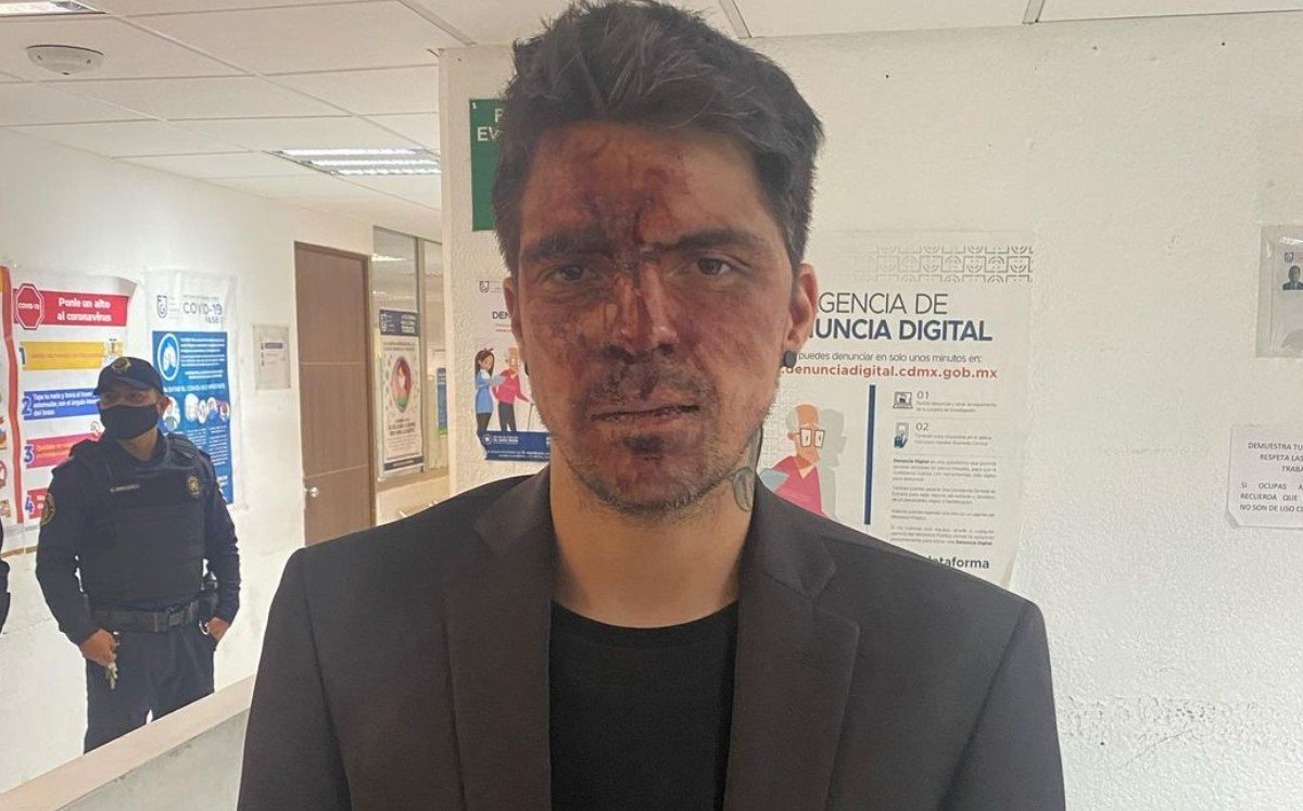César Dalessio. Hijo de Lupita Dalessio golpeado de Arturo Montiel PRI